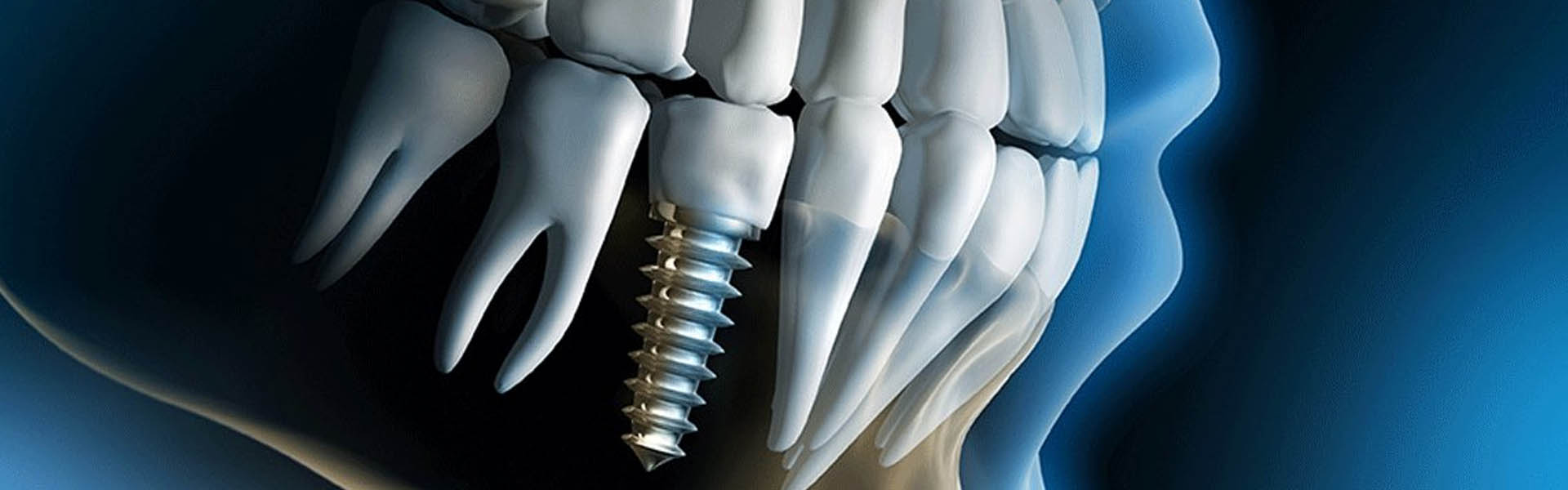 dentalimplants.jpg