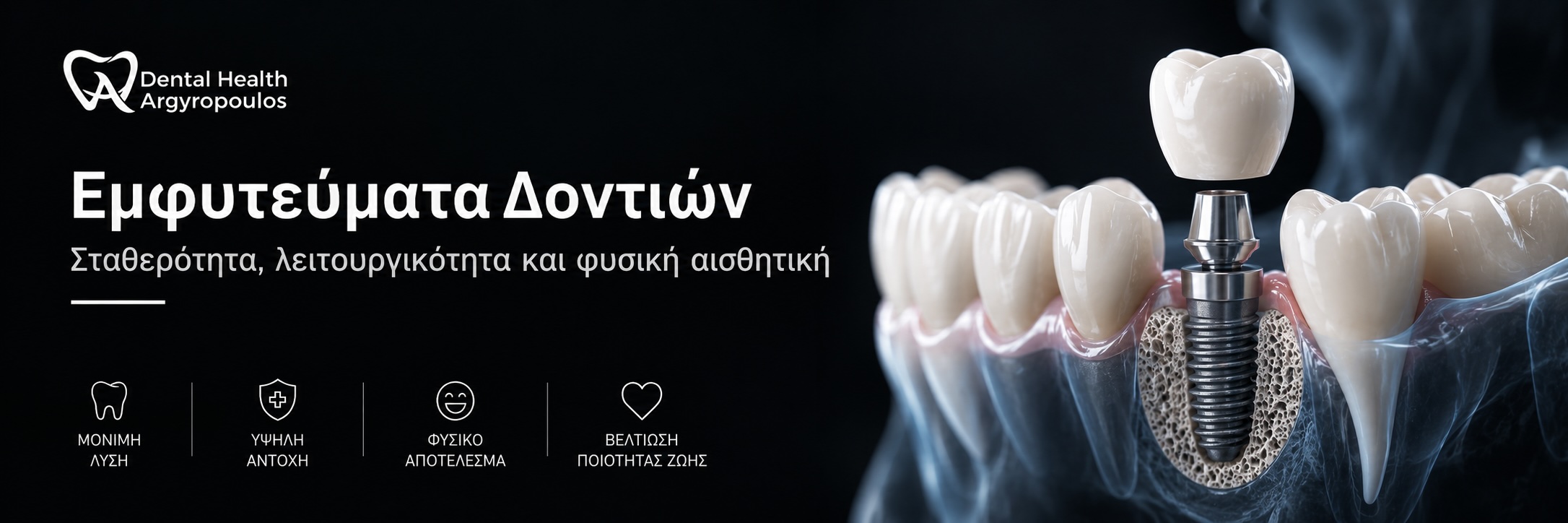 Ψηφιακός σχεδιασμός και τοποθέτηση οδοντικών εμφυτευμάτων στην Πάτρα