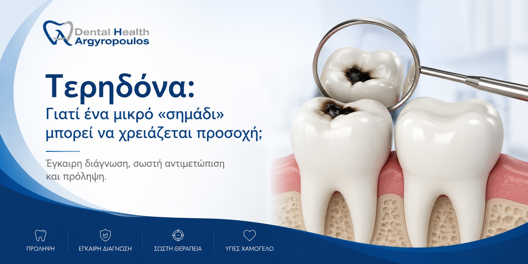 Επεξηγηματική εικόνα για την τερηδόνα, τα αρχικά σημάδια της βλάβης και τη σημασία της έγκαιρης οδοντιατρικής διάγνωσης.
